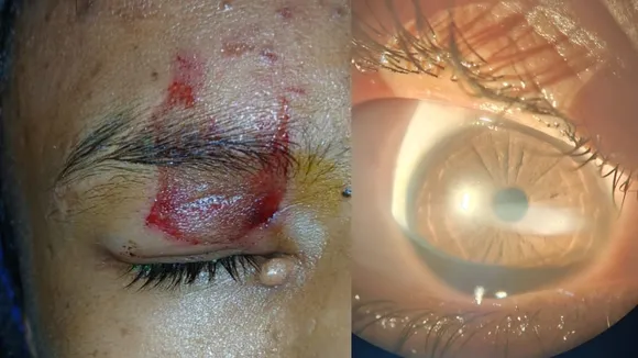 CHILDREN EYE INJURED