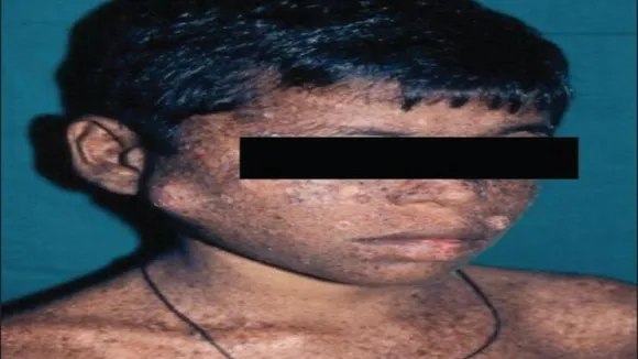 Chamarajanagar: Unusual incidence of Xeroderma Pigmentosum