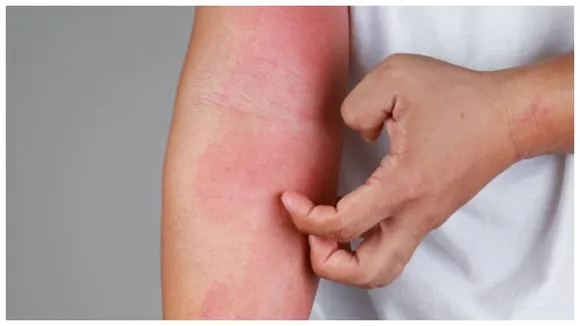 Winter woes: Bengaluru records surge in Eczema cases as temperatures drop