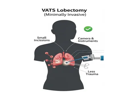 Minimally invasive VATS lobectomy at Porunai Hospital using small incisions and a camera to reduce lung trauma and speed up recovery