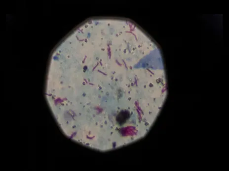 A sample that tested positive for tuberculosis is seen from a microscope (Image/Reuters)