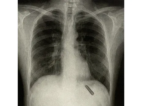 X-ray of the patient (Photo/ANI)