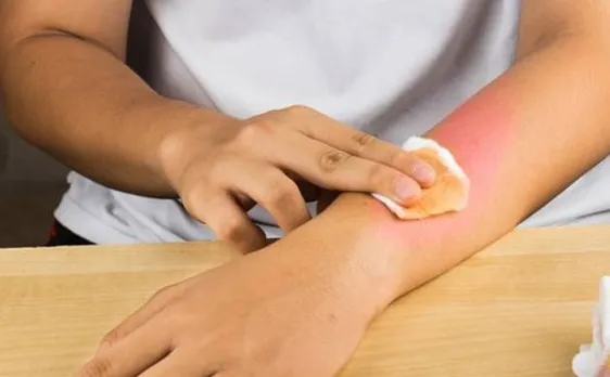 Scientists successfully create artificial skin that may help burn victims