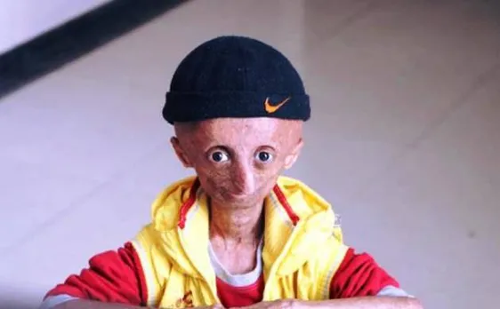 15-year-old Progeria kid Nihal Bitla passes away in Telangana