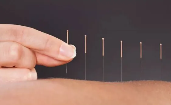 Acupuncture reduces menopause related hot flashes, night sweats says study