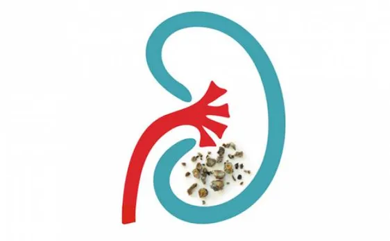 Natural fruit extract may prevent, reduce kidney stones 