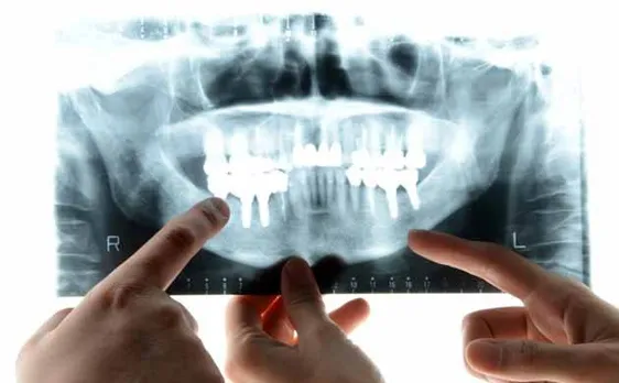 Origin of human teeth may be revealed from 3D-printed fish fossil