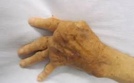 Arthritis drug may help treat rare eye disease
