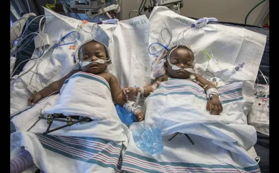 Conjoined twin girls from Nigeria separated after lengthy operation in US 