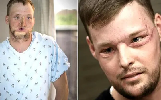 Video: Man gets new identity after successful 50-hour face transplant in US