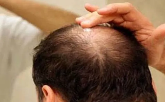 Short, bald men more likely to get cancer early
