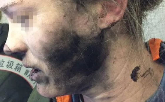 Woman suffers face burns as battery headphones explode during flight on Australia