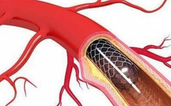 Healthcare major Abbott revokes two stent types from India
