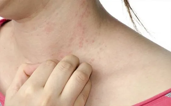 Eczema caused by deficiency of protein in skin, confirm scientists