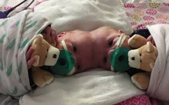 Rare surgery: Doctors successfully separate twin girls joined at the head at Childrenâ€™s Hospital of Philadelphia
