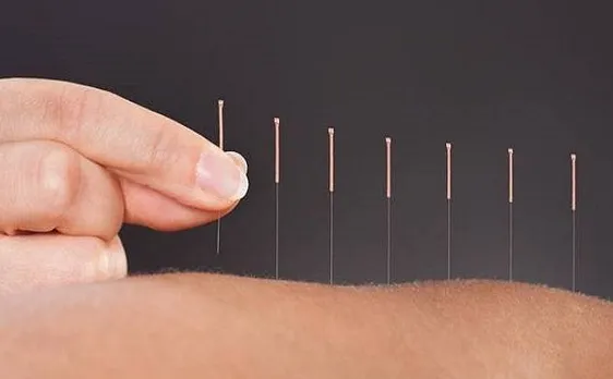 Acupunture may provide relief from pain on long term basis, says study