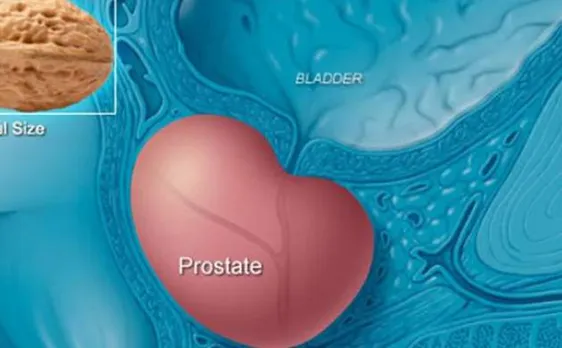 Scientists develop three-in-one blood test for precision prostate cancer therapies