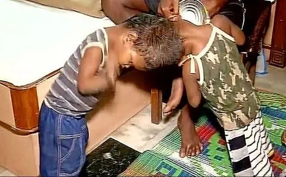 New Delhi: AIIMS doctors to perform Craniopagus surgery to separate Odisha twins joined at head