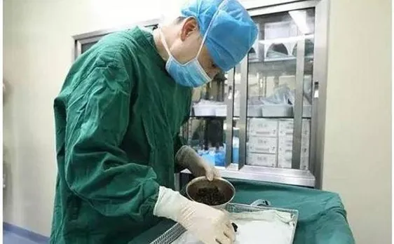 Chinese woman develops gallstones in bladder as result of skipping breakfast for 8 years