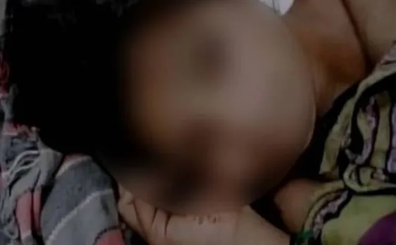 Bareilly (UP): 2 sisters suffer critical burns after unknown persons set them on fire at home 