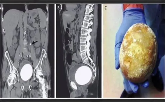 Stone as big as an Ostrich egg removed from man's bladder, doctors California hospital shocked