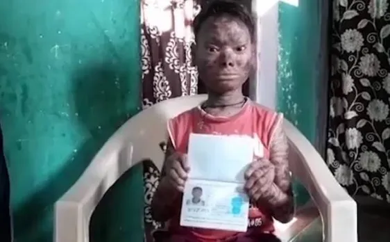 Teenager suffering from rare congenital disease gets Spanish help 