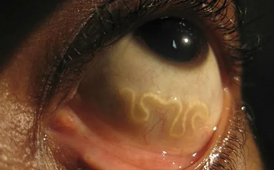 What? Parasite caused blindness in Mexican boy