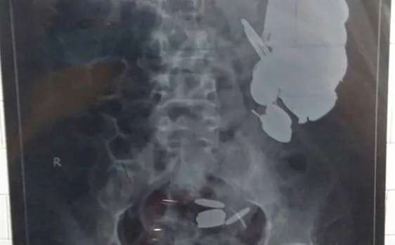 Doctors successfully remove 72 coins from Palghar man's stomach