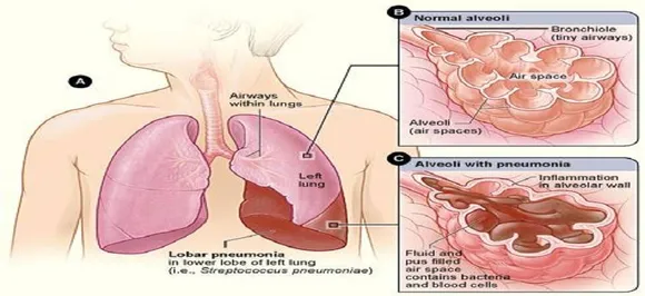 Pneumonia, major cause of death in India