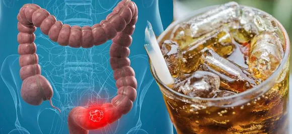 Colon Cancer â€“ Diet Soda may help avoid recurrence