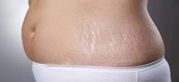  Simple home remedies to get rid of cellulite