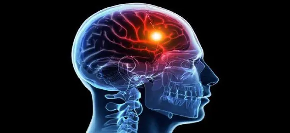 World Stroke Day: Stroke symptoms you should never ignore