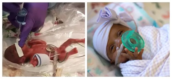 World's smallest baby, weighing no more than an apple is now a healthy infant, goes home after 5 months in intensive care