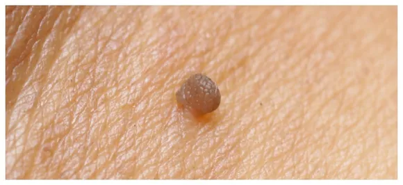What are skin tags? And how do remove them naturally at home