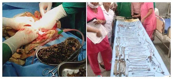 Prepare to make your stomachs turn! Doctors remove 1.5 kg of coins, jewelleries from womanâ€™s tummy
