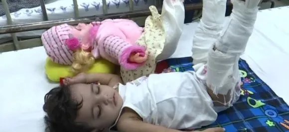 Doctors Plaster 11-Month-Old's Doll To Convince Her For Treatment Of Fracture