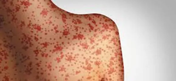 Measles Outbreak Wreaks Havoc In New Zealand: All About The Potentially Fatal Illness