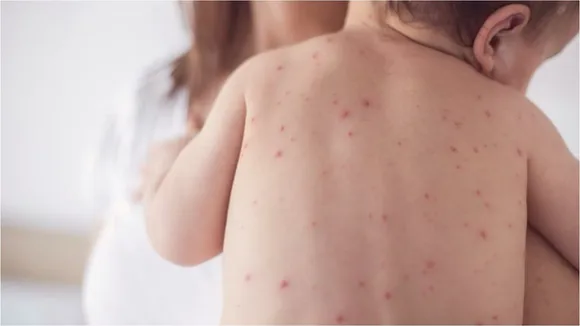 Measles Wipes Out Immune System's Memory Of Past Infections: Study