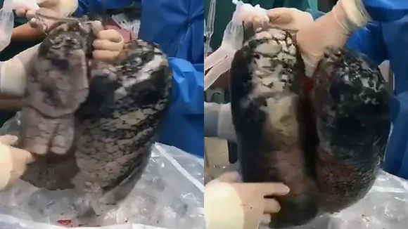 Watch: Horrifying Viral Video Shows What Happens To Your Lungs After Years Of Smoking