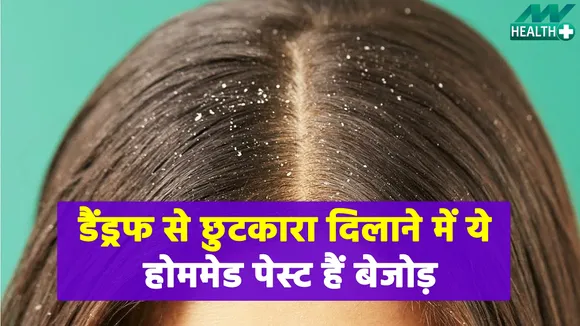 Homemade Pastes can be a cure for Dandruff