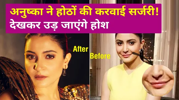 Anushka got the surgery done! such a condition of the lips