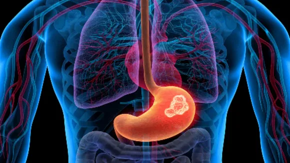 Stomach Cancer
