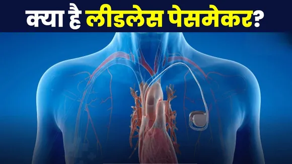 Leadless Pacemaker