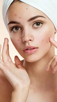 pimples