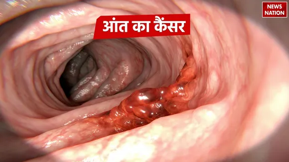 Colon or Bowel Cancer