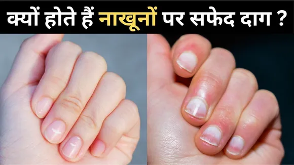 white spots on nails causes