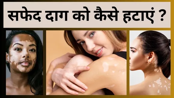 सफेद दाग