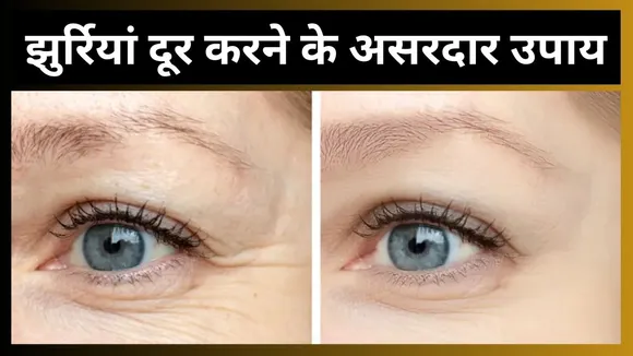Under Eye Wrinkles Remedies