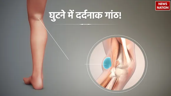 Bakers cyst