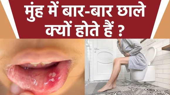 Mouth Ulcers
